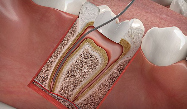 Wurzelkanalbehandlung